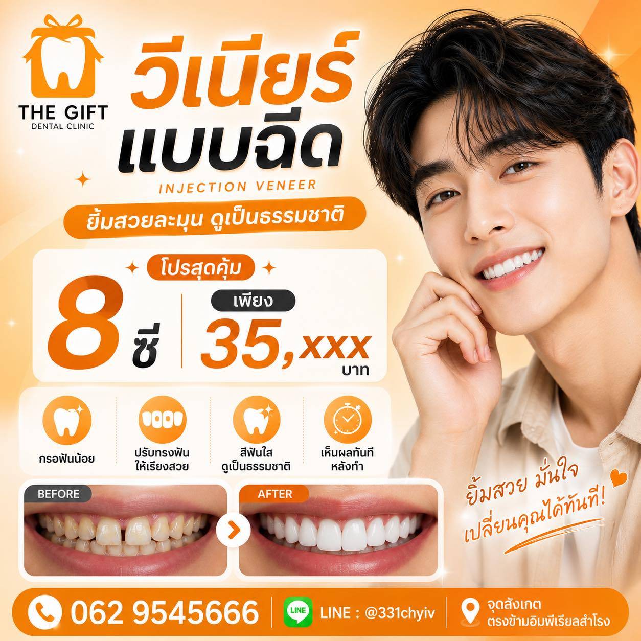 วีเนียร์ (Veneers) แปะผิวฟัน