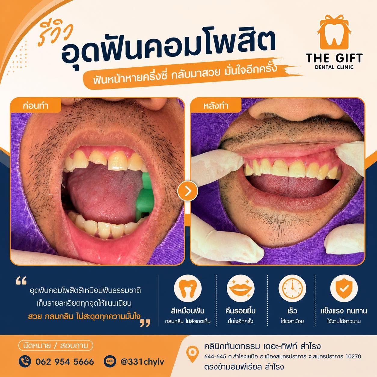 ฟันหน้าหัก ฟันแหว่ง ไม่ต้องปล่อยให้รบกวนความมั่นใจ รู้จักการบูรณะฟันหน้าด้วยคอมโพสิตวีเนียร์