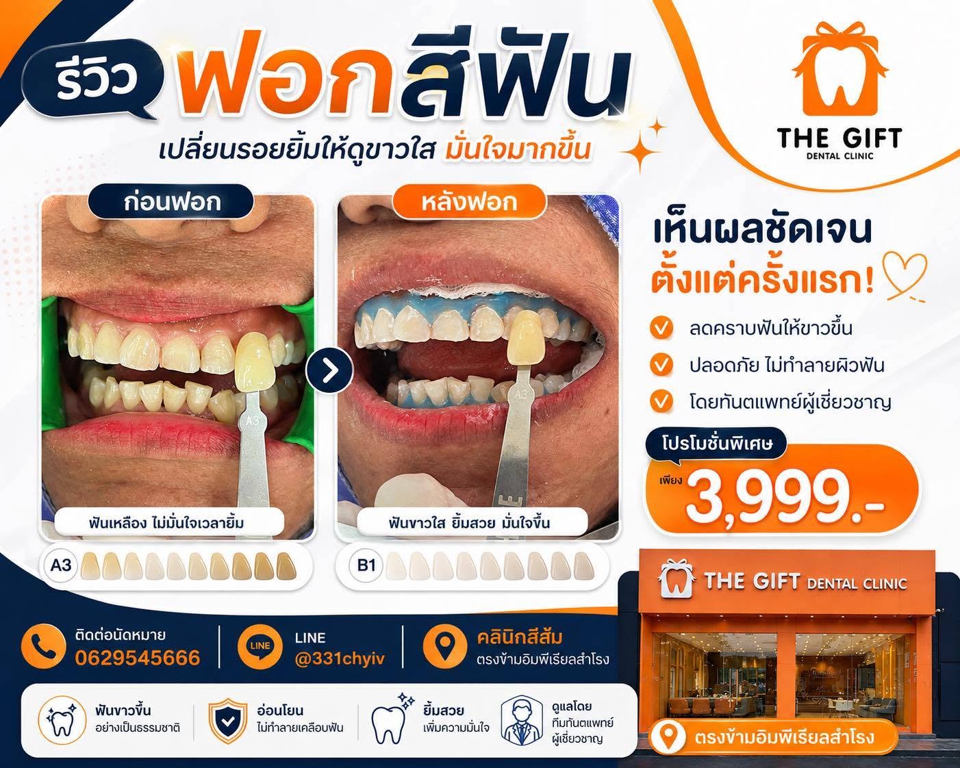 ฟันเหลือง ทำยังไงดี ? ฟอกสีฟันช่วยได้หรือไม่
